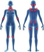 Fibromyalgia